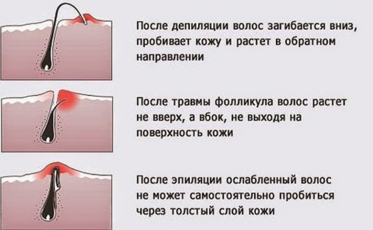 Причины врастания волос